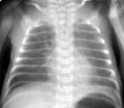 Синдром Дыхательного Расстройства Реферат